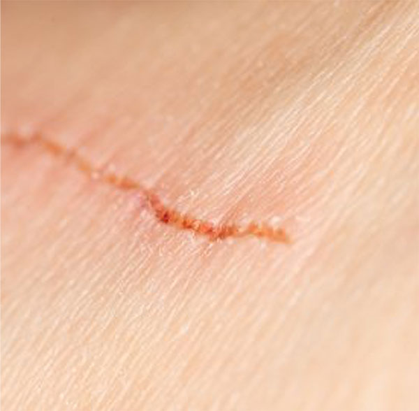 Research: Image of a scar